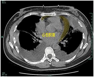 心脏|脚上一按一个坑！五旬大妈心上长了层“铠甲”，看医生如何化险为夷