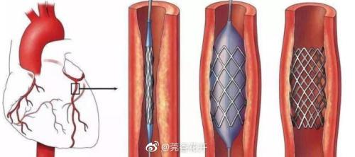 东莞7家医院患者已用上几百元的冠脉支架