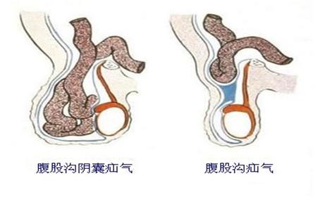 『你的育儿经』疝气老人小孩都易得，先天和后天应如何分辨，专家告诉你答案