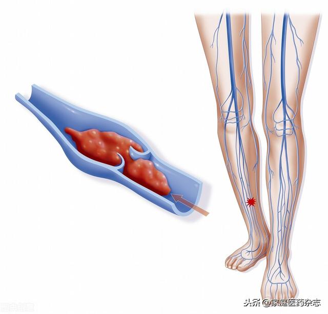 多吃这4类食物，有效预防下肢深静脉血栓