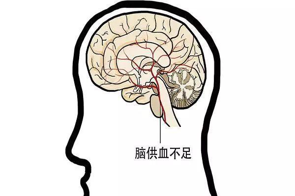 脑供血不足|脑供血不足，人身上容易有3个异常