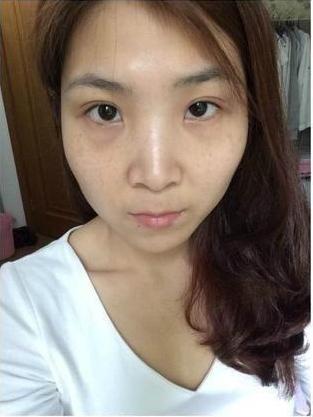 超级宝妈■来自湖南的王女士，从25岁怀孕时就开始长斑，现在斑已经没有了