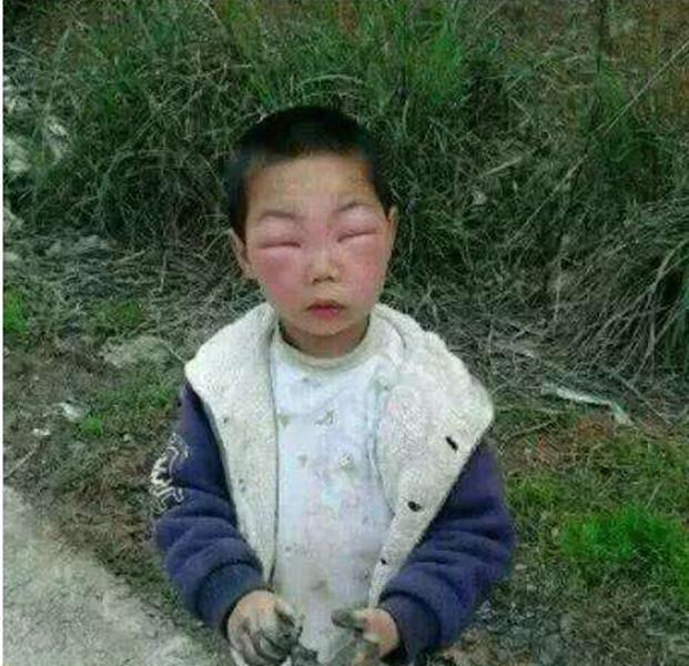 你的育儿经■熊孩子兄妹误捅马蜂窝，脸肿得爹妈不敢认，网友：不该笑但忍不住