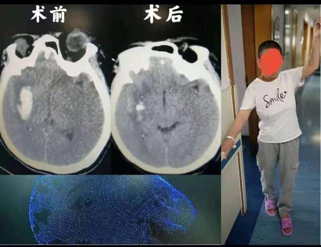 手术|患者偏瘫入院，手术后走出医院，“3D结构光”机器人开拓脑出血治疗领域