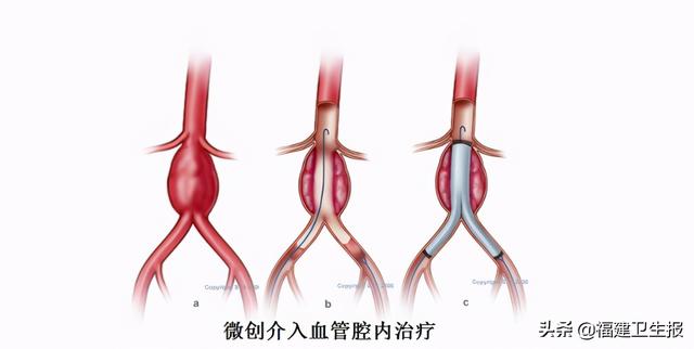 血管|肚子里长了个东西和心脏同时跳动，泉州老太查出体内有“血管炸弹”，全家吓坏了