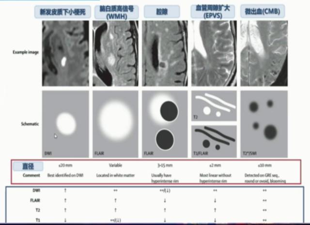 脑小血管病如何诊治？这一篇讲清楚了