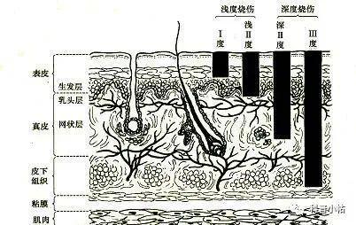 烫伤|一个烧伤整形科医生的值班经历：一个月遇见3个拔火罐烫伤