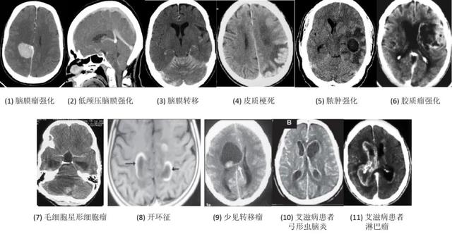 什么是 CT 增强？强化程度、模式、扫描时相等问题逐一解答