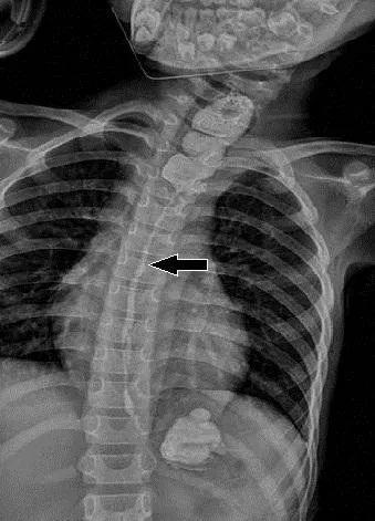食管|广东9岁女孩喝了桌上“一口水”，致食管萎缩无法进食......
