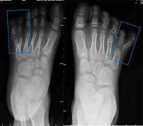 25 个病例 50 多幅图像告诉你手足畸形是个什么样子