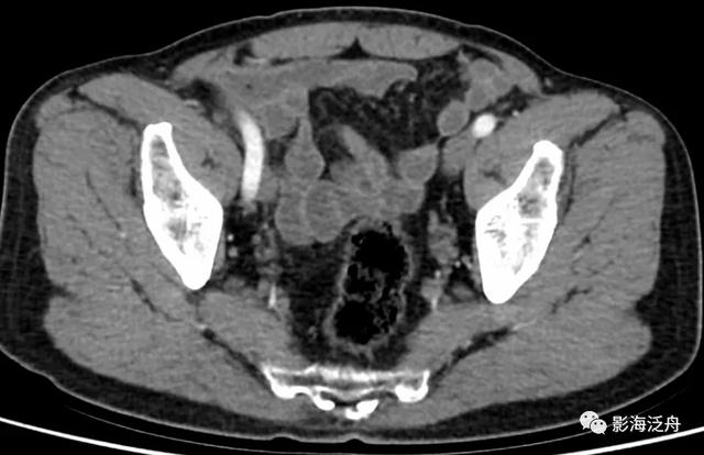 这个病，腹部CT经常会漏诊