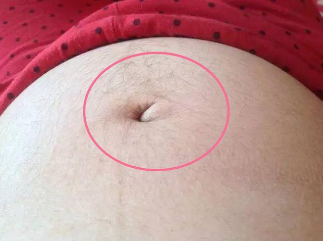 超级宝妈▲怀孕为什么准妈肚子上会“长毛”?老人说是生男宝,果真如此吗?