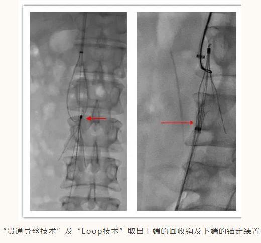 滤器|3175天！国内医疗界的这项纪录被打破