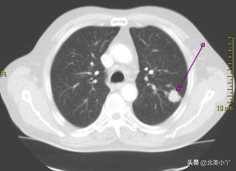 不是所有人都适合CT筛查肺癌，要明白这些事，减少CT检查带来风险