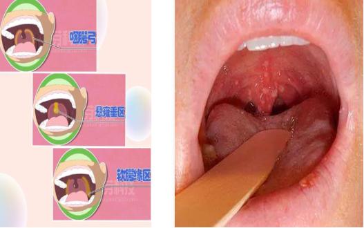 疱疹|这种疾病6岁以下孩子高发，如何预防看这里