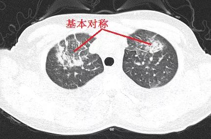 「典型」的肺水肿，为何用抗生素狂轰滥炸？