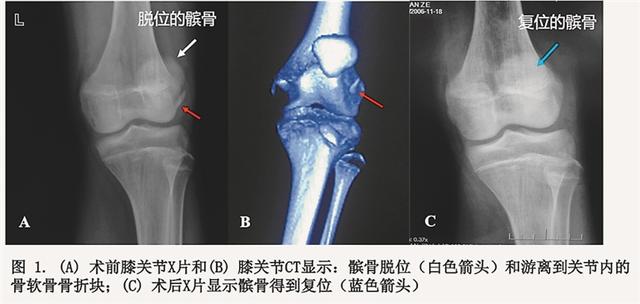 髌骨|14岁男孩打篮球跳落时骨折！医生提醒：运动损伤后冰敷、不能活动