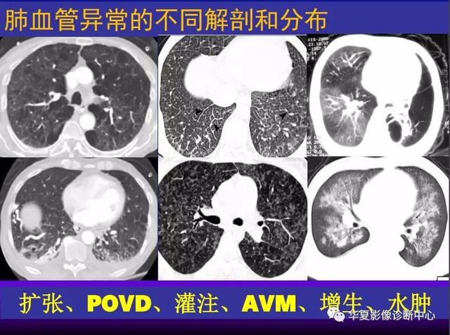 肺间质性疾病的解剖、病理、影像分析