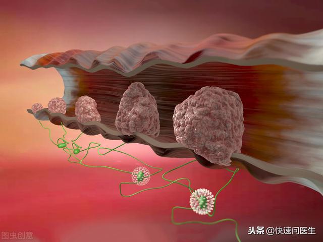 放屁带出黏液，是肠癌？医生提醒：如果出现这三种情况就需谨慎