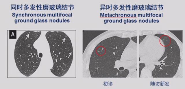 单发结节和多发结节哪个更危险？有好几个结节，要做多少次手术？