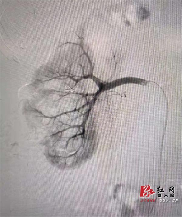出血|嘉禾县中医医院：微创介入 妙手回春