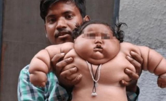 [超级宝妈]1岁体重就高达45斤的“米其林宝宝”，如今啥样了？不出人们所料