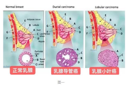 乳腺癌到底从哪里来