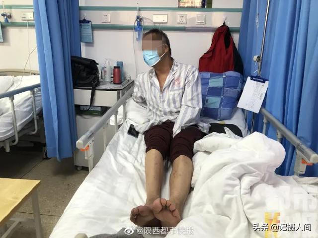 咋回事？男子双腿突然冰凉疼痛难忍！医生：接近坏死的程度