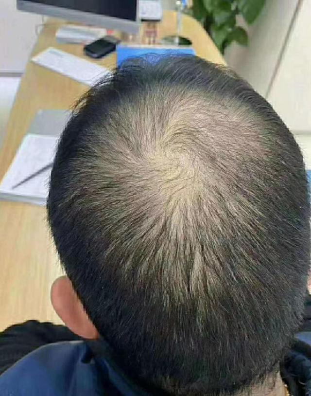 非那雄胺的真实有效率是多少（五位发友改善一年，终于告别稀疏）