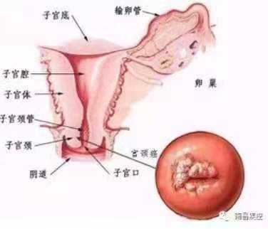 筛查|宫颈癌筛查，你做对了吗？