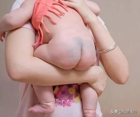 超级宝妈|宝宝屁股上的“淤青”是什么？长着长着还会消失