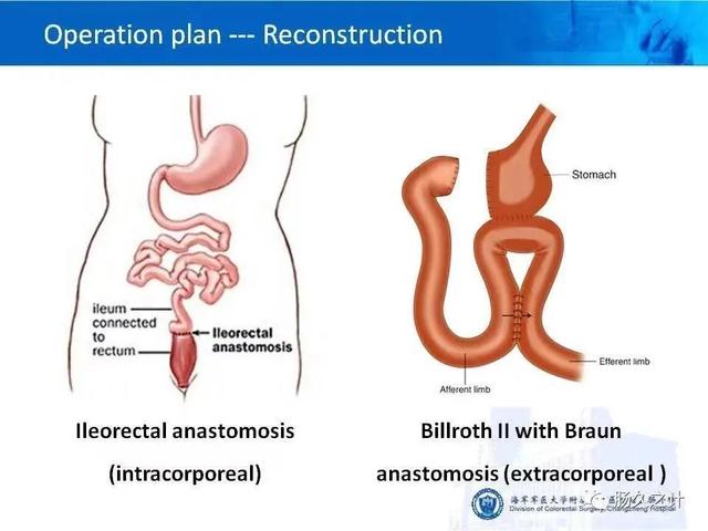 手术|长征医院肛肠外科周海洋教授在英国肛肠协会会刊发表系列手术视频