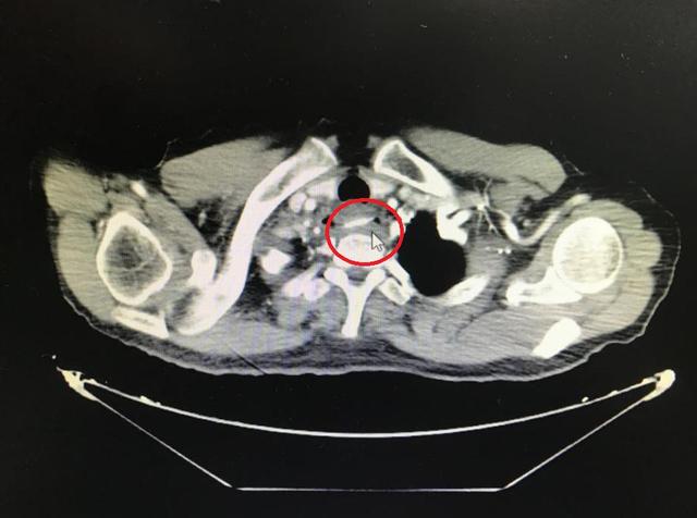 主动脉|10个科室30位专家参与大抢救，就因为一根鱼刺
