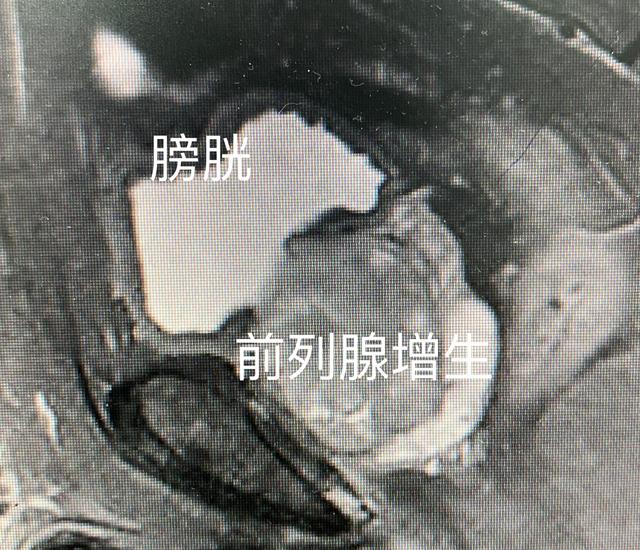 小便带血，医生我该怎么办？别紧张，泌尿外科医生告诉你