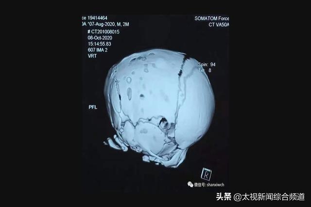 太原：宝宝畸形修复，医生借3D打印做手术