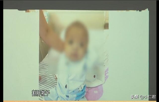 超级宝妈|6月大婴儿患罕见遗传病，严重肝衰竭命悬一线，伟大母亲割肝救子