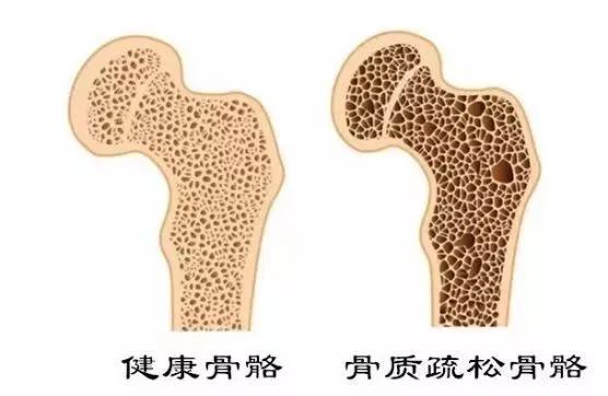 骨折|骨损伤康复不能只靠“喝骨头汤”| 健康长寿36计