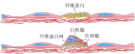 长途旅途中需要防范——深静脉血栓