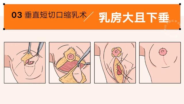 各类人群的乳房缩小术