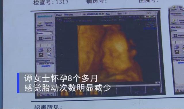 超级宝妈@胎儿调皮把脐带玩成“麻花状”，别急着夸娃聪明，背后暗藏凶险