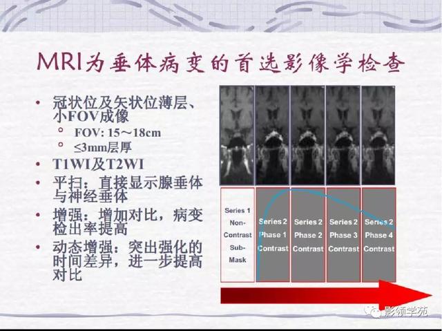 垂体病变的MRI诊断