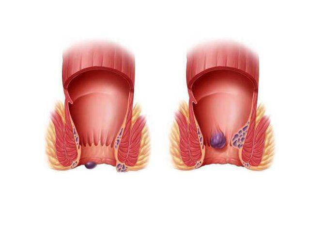 肛门长了个"小肉球",是痔疮吗?若是痔疮,一片树叶就够