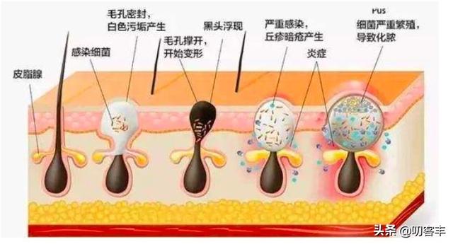 青春期|青春痘怎么治？