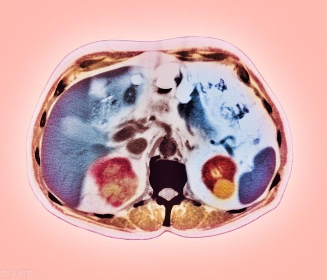 肾囊肿严重可致尿毒症！6个早期信号，希望你能早点了解