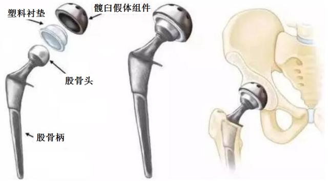 名医专访丨上海市第十人民医院郑龙坡：坏死的股骨头能否保住？