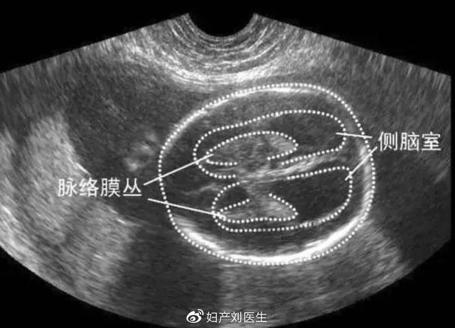 【你的育儿经】侧脑室增宽孩子一定有问题吗?