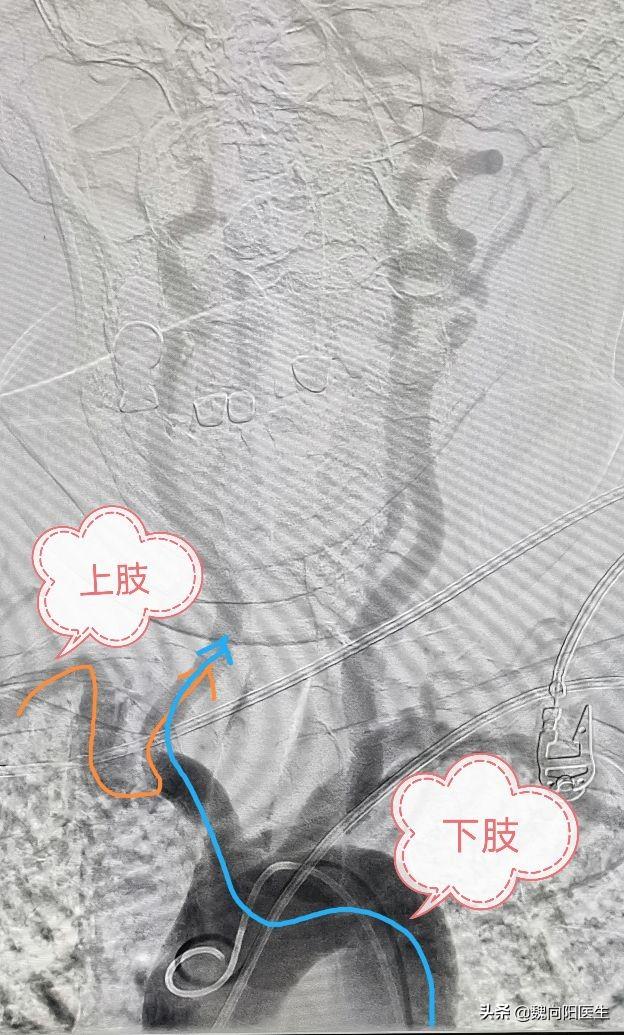 为什么心脏造影从胳膊做？而脑造影必须从腿做？