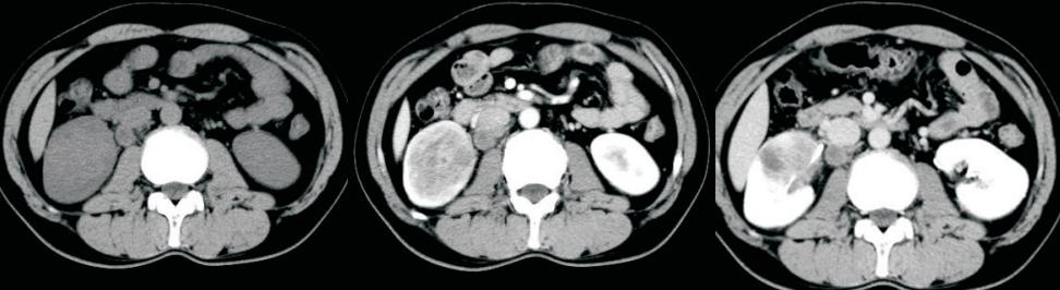 少见典型肾肿瘤一例，也容易误诊的病例