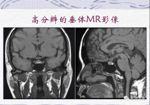 垂体病变的MRI诊断