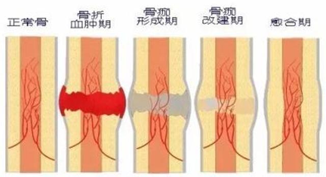 手术|「辟谣」手术是为了促进骨折愈合？错！敷中药往往更能促进愈合